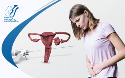 استئصال كيس على المبيض بالمنظار