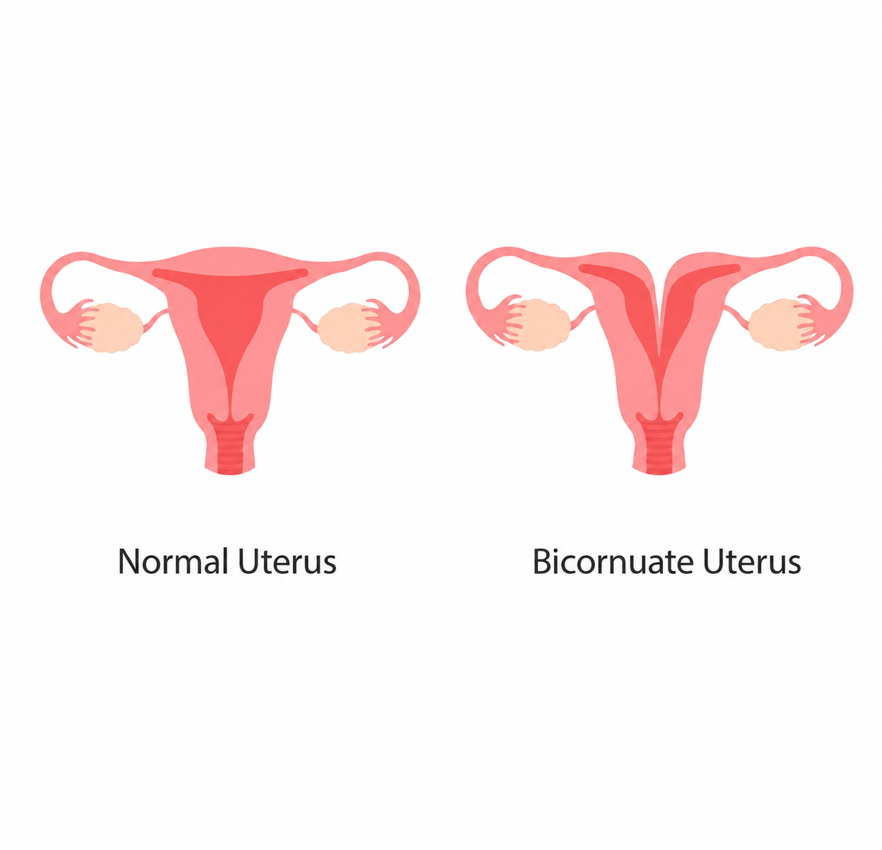 graph showing bicornuate uterus vs normal uterus