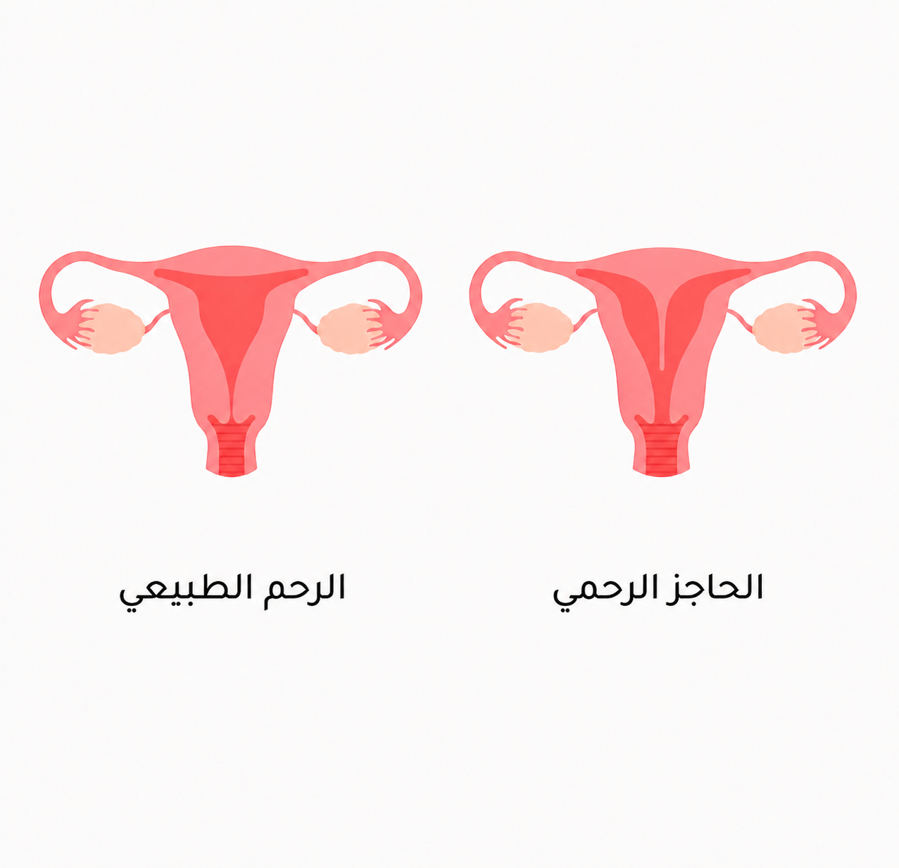 مقارنة بين الرحم الطبيعي والرحم ذي الحاجز الرحمي