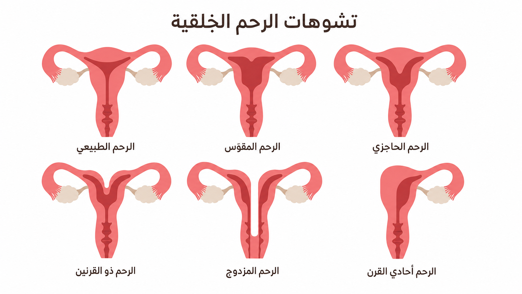 مقارنة بين الرحم الطبيعي وأنواع تشوهات الرحم الخلقية مثل الرحم الحاجزي وذي القرنين والمزدوج وأحادي القرن