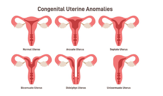Comparison of a normal uterus and types of congenital uterine abnormalities, including septate, bicornuate, arcuate, didelphys, and unicornuate uterus